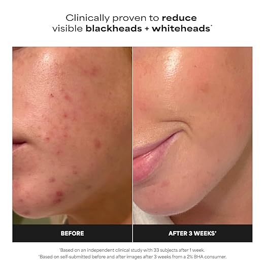 Paula’s Choice 2% BHA Liquid Exfoliant – Salicylic Acid Pore Minimizer for Blackheads & Fine Lines (118ml)