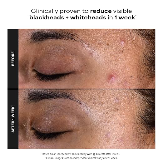 Paula’s Choice 2% BHA Liquid Exfoliant – Salicylic Acid Pore Minimizer for Blackheads & Fine Lines (118ml)