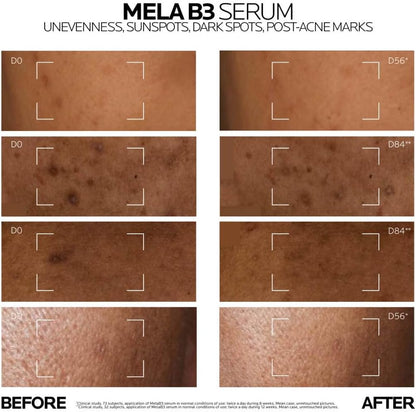 La Roche-Posay Mela B3 Niacinamide Serum 30ML - before and after comparison