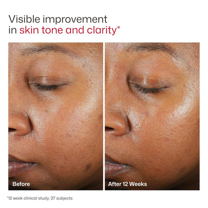 EltaMD UV Clear Tinted Sunscreen SPF 46 48g - before and after comparison (view 2)